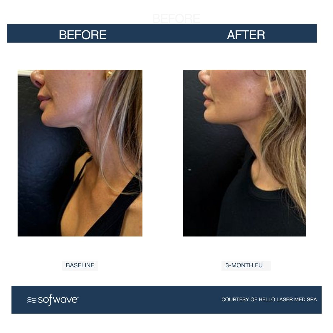 Sofwave submental result