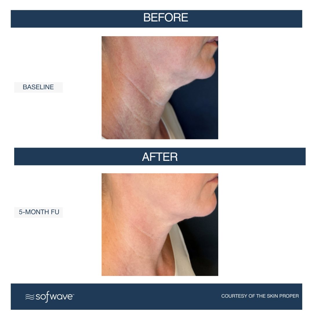 Sofwave lower face and neck result