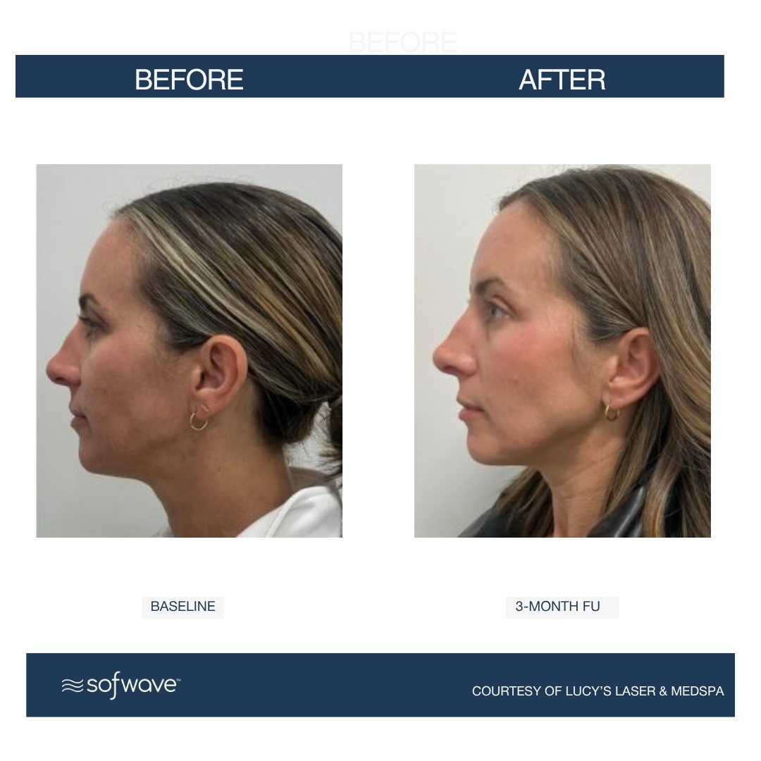 Sofwave profile result