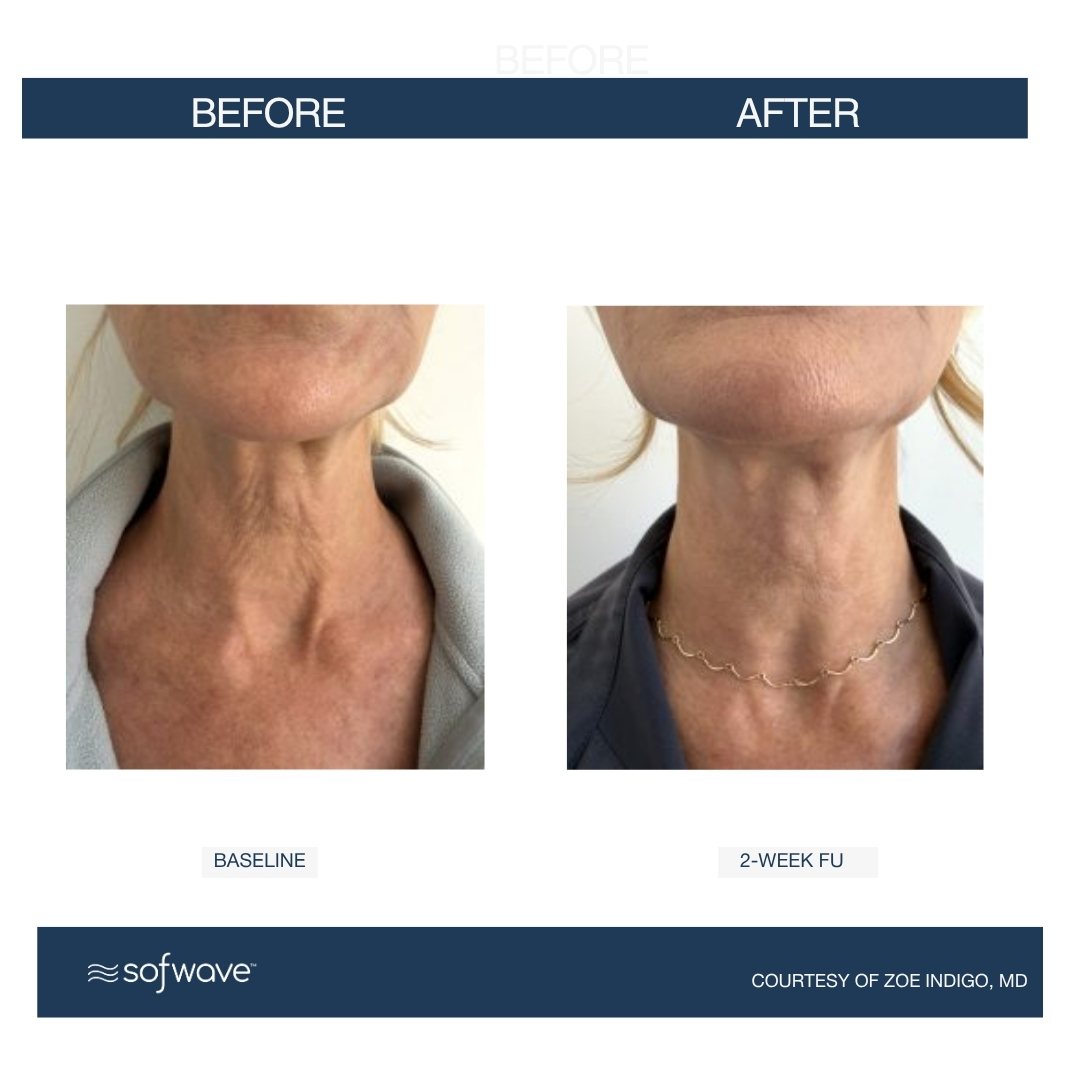 Sofwave neck result